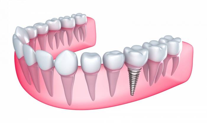 Dental-implant